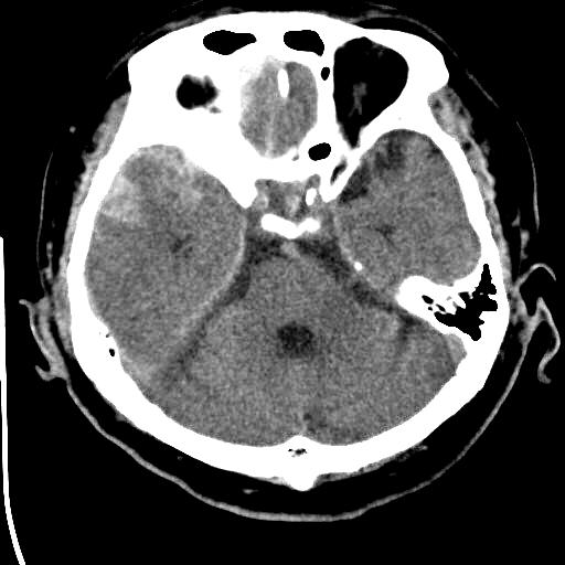 Medicine Traumatic Sdh And Contusional Hemorrhage